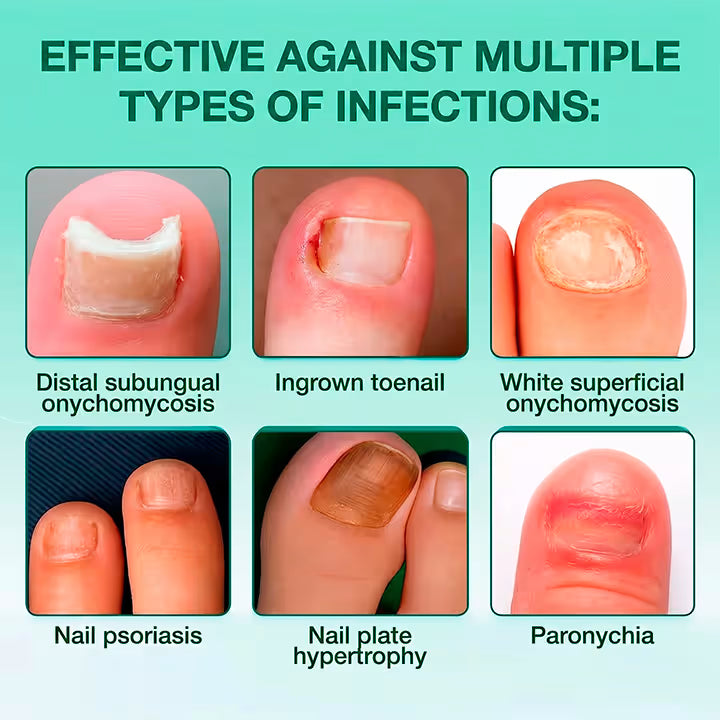 NailLab™ — Fungal Nail Patches